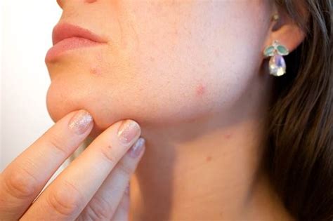 Red Spots On Face 10 Home Remedies To Get Rid Of Petechiae On Face