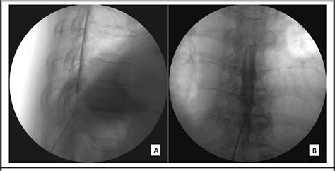 Fluoroscopically Guided Thoracic Interlaminar Epidural Injection A