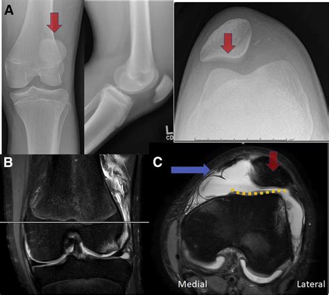 Roux Goldthwait And Medial Patellofemoral Ligament Reconstruction For