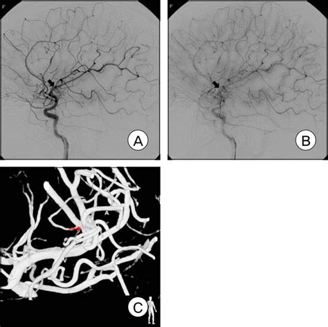Preoperative Cerebral Angiography Of The Patient A A Possible