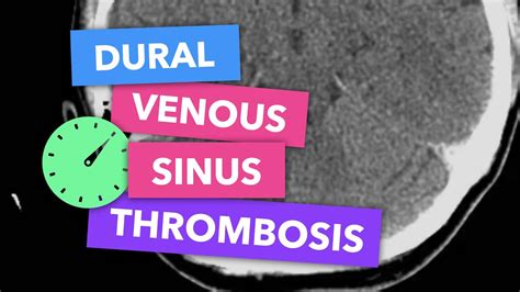 Dural Venous Sinus Thrombosis Radiopaedias Emergency Radiology