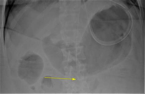 End Of The Line Central Venous Catheter Mishap Bmj Case Reports