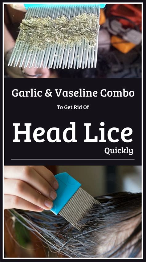 Garlic And Vaseline Combo To Get Rid Of Head Lice Quickly