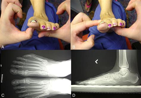 Symptomatic First Metatarsocuneiform Nonunion Revised By Arthroscopic