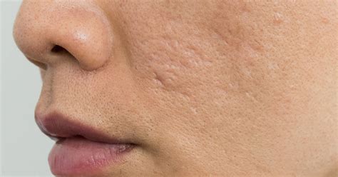 Treating Rolling Acne And Box Scars A Doctor Shares Tips