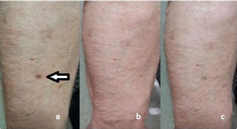 Cryotherapy For Common Premalignant And Malignant Skin Disorders