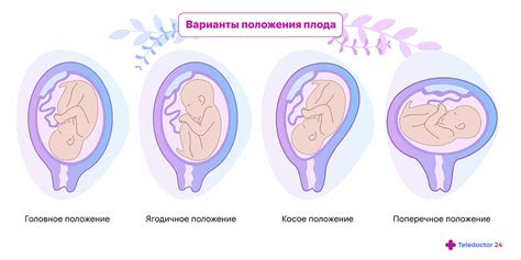 Как определяется положение плода при беременности