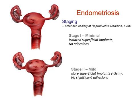 Endometriosis happens when the endometrium, tissue that usually lines the inside of your uterus, grows outside it. Endometriosis - International Women's Clinic