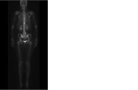 Rare Aggressive Form Of Multiple Myeloma With Diffuse Osteosclerosis