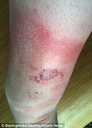 But just how dangerous are they and what do you need to know about them? 'Spider bite nearly cost me my leg': Basingstoke carer ...