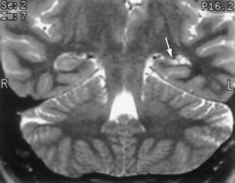 Example Of Mesial Temporal Sclerosis On T2 Weighted Mr 370090