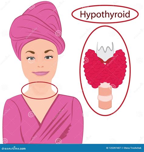 Goiter Enlarged Thyroid Stock Vector Illustration Of Hyperthyroid
