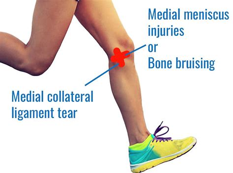 Knee Pain In Runners A Quick Guide
