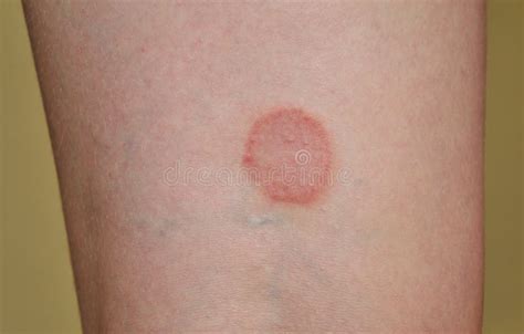 Lichen Ruber Planus Stock Photo Image Of Rash Allergies My Xxx Hot Girl