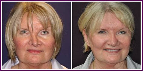 Patient Before And After Facial Plastic Surgery In Sydney By Dr