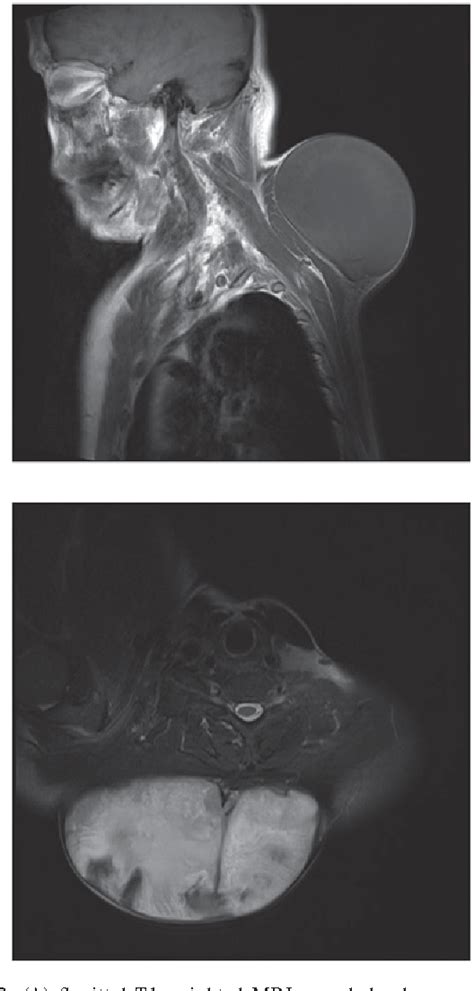 Figure 2 From Giant Epidermal Cyst In The Posterior Neck Developing