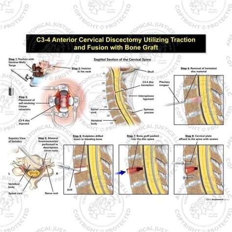 Male C3 4 Anterior Cervical Discectomy Utilizing Traction And Fusion