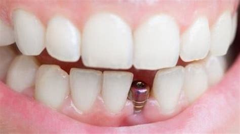 How Long Do Dental Implants Last Dental Implants By Best Dentists In