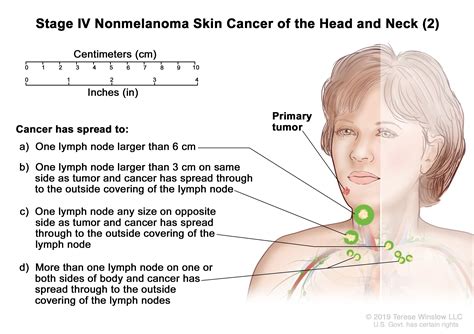 Skin Cancer Treatment Pdq®patient Version National Cancer Institute
