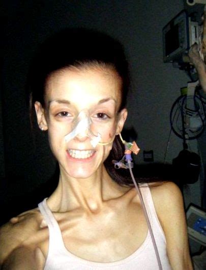 Döbbenetes Képek Anorexiás Betegekről Akik Napi 50 000 ülést Végeztek