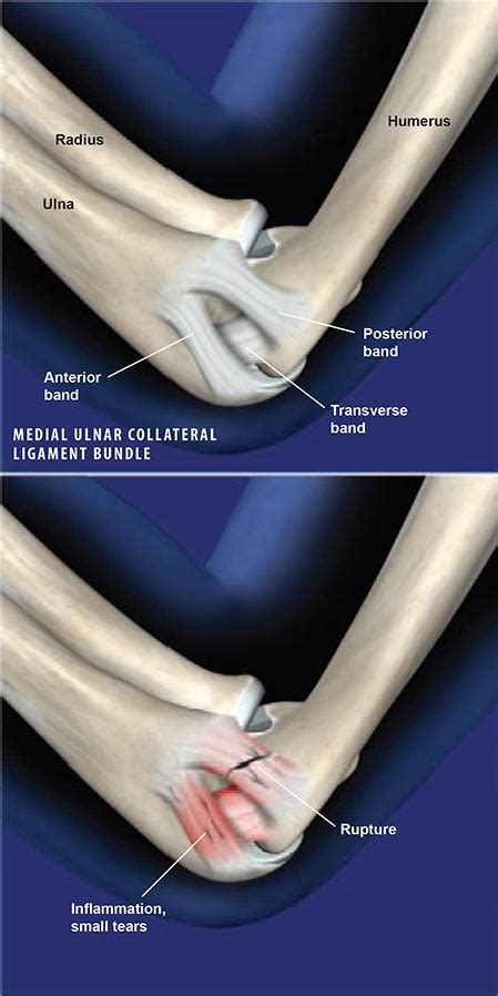 Medial Ulnar Collateral Ligament Injury Central Coast Orthopedic