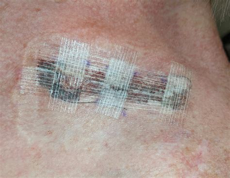 Healing After Skin Cancer Surgery Mastering The Process