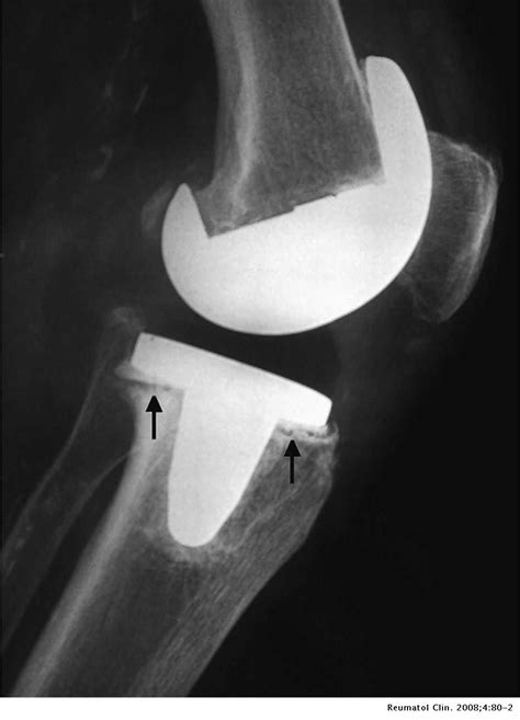 Sobrina Desear Madurar Liquido Sinovial En Protesis De Rodilla