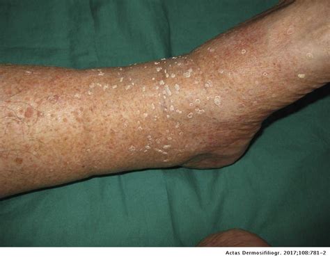 Hyperkeratotic Lesions On Legs Actas Dermo Sifiliográficas
