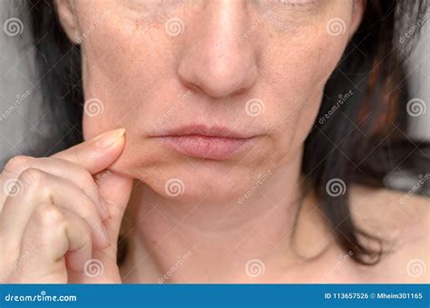 Woman Pinching The Skin Of Her Cheek Stock Photo Image Of Lower