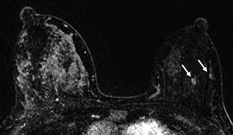 Breast Imaging Of The Pregnant And Lactating Patient Imaging