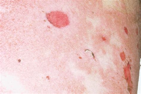 Bullous Pemphigoid Nidirect