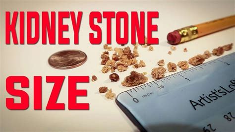Actual Kidney Stone Size Chart In Mm
