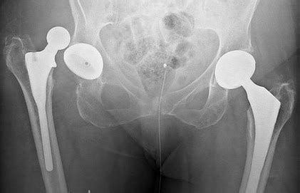 For example, if your cat has a ball replacement for a hip dislocation it is not likely to get an additional. Revision Hip Replacement Surgery in India - Healing Touristry