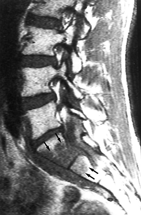 Non Hodgkins Lymphoma Presenting With Spinal Involvement Annals Of