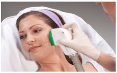 Endymed Fractional Skin Resurfacing At Cheshire Lasers Middlewich
