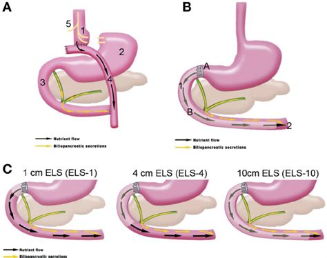 A Anatomical Components Of Roux En Y Gastric Bypass Rygb 1