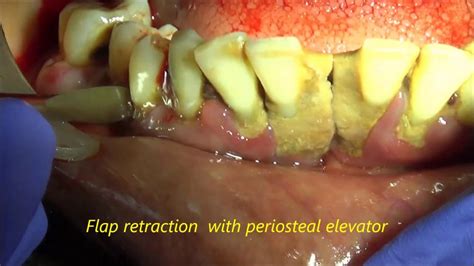 Lower Full Mouth Extraction With Alveoloplasty Youtube