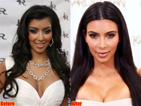 Kim Kardashian Cosmetic Surgery Before And After Photos