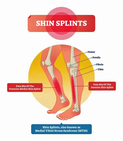 15 Tips On How To Prevent And Treat Shin Splints