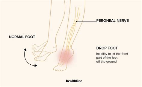 Drop Foot Causes Treatments And More