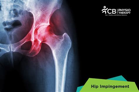 What Is Hip Impingement Symptoms Causes Diagnosis And Physiotherapy