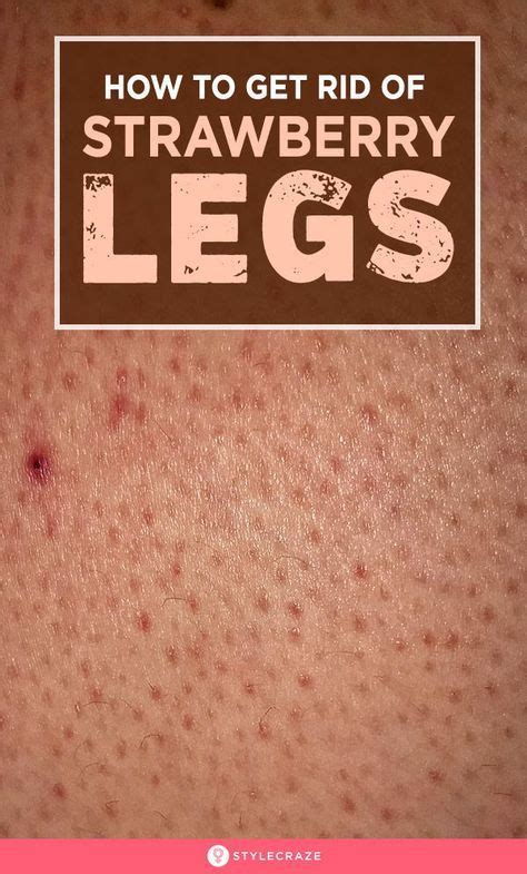 10 Natural Ways To Get Rid Of Strawberry Legs Strawberry Legs Dark