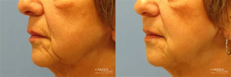 Non Surgical Facelift Before And After Gallery Patient 1