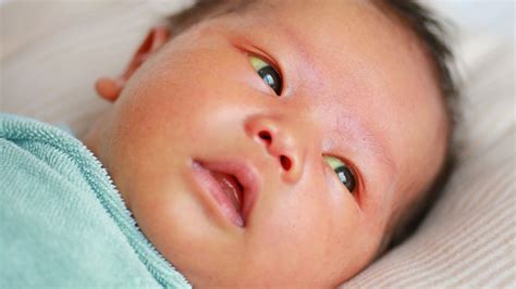 Jaundice In Newborn Babies Private Gp And Wellness Clinic Belfast