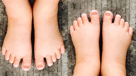 Swollen Feet During Pregnancy Natural Remedies