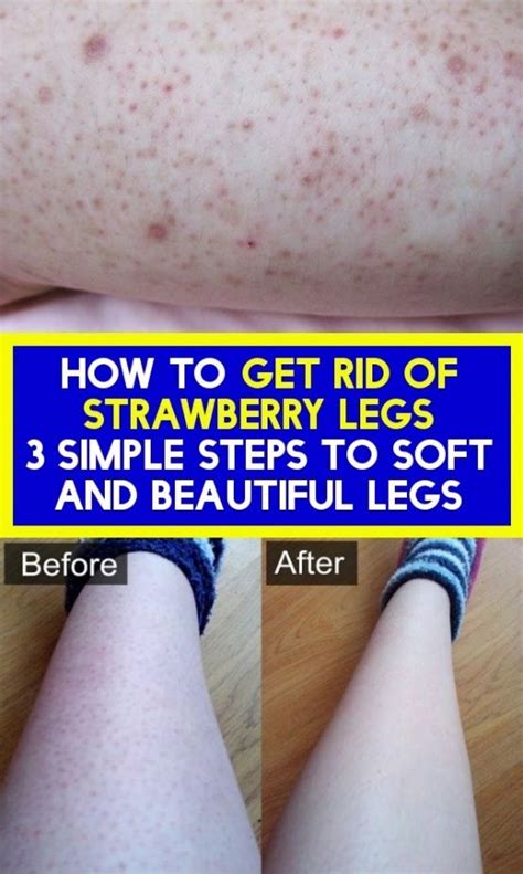 Get the tools that they trust. How to get rid of the strawberries of legs - 3 easy steps ...