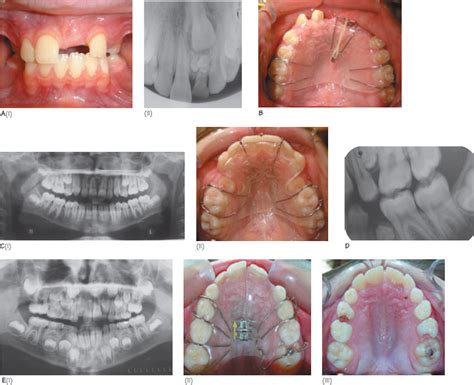 31 Impacted Teeth Pocket Dentistry