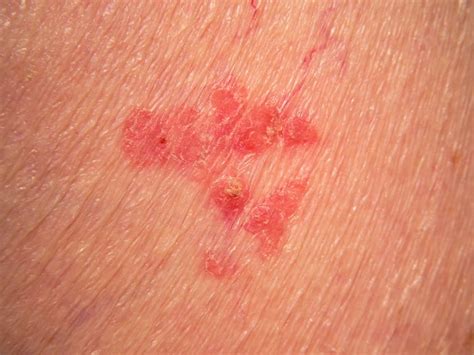 Bowen's disease itself is not usually serious. Photo Gallery of Skin Cancer by Type