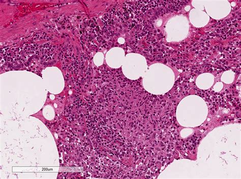 Pathology Outlines Lymphoid Interstitial Pneumonia