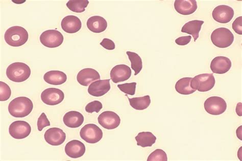 Anemia Iron Deficiency Diseases And Conditions